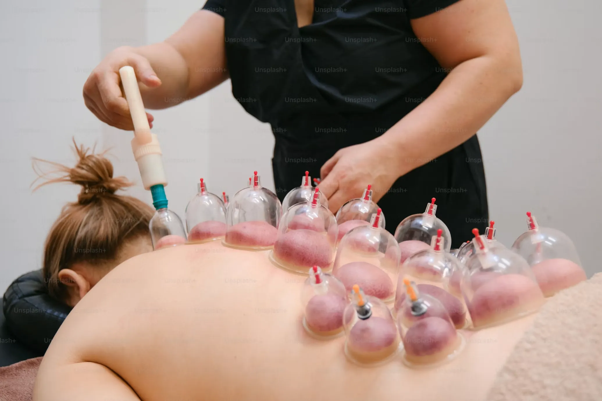 Hijama · cupping